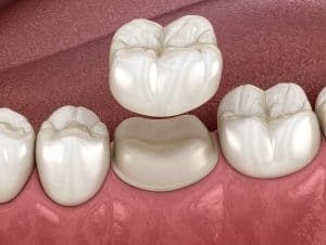 коронки для жевательных зубов