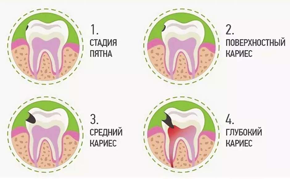 Стадии кариозного поражения зубов у детей